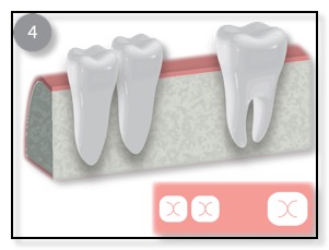 bone grafting has healed diagram